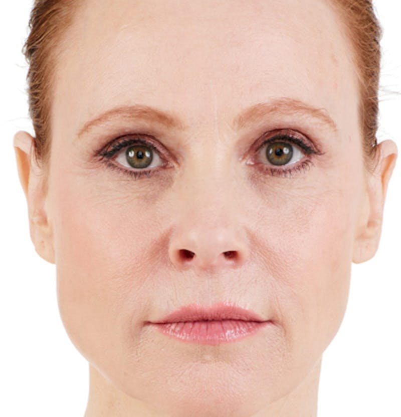 Facial Fillers Before & After Gallery - Patient 65918902 - Image 2