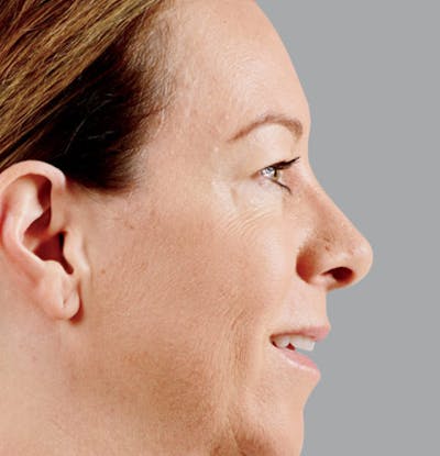 Facial Fillers Before & After Gallery - Patient 65918903 - Image 1