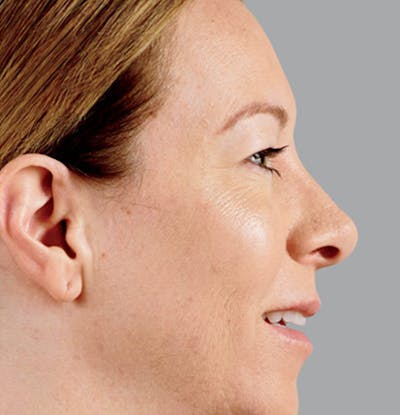 Facial Fillers Before & After Gallery - Patient 65918903 - Image 2
