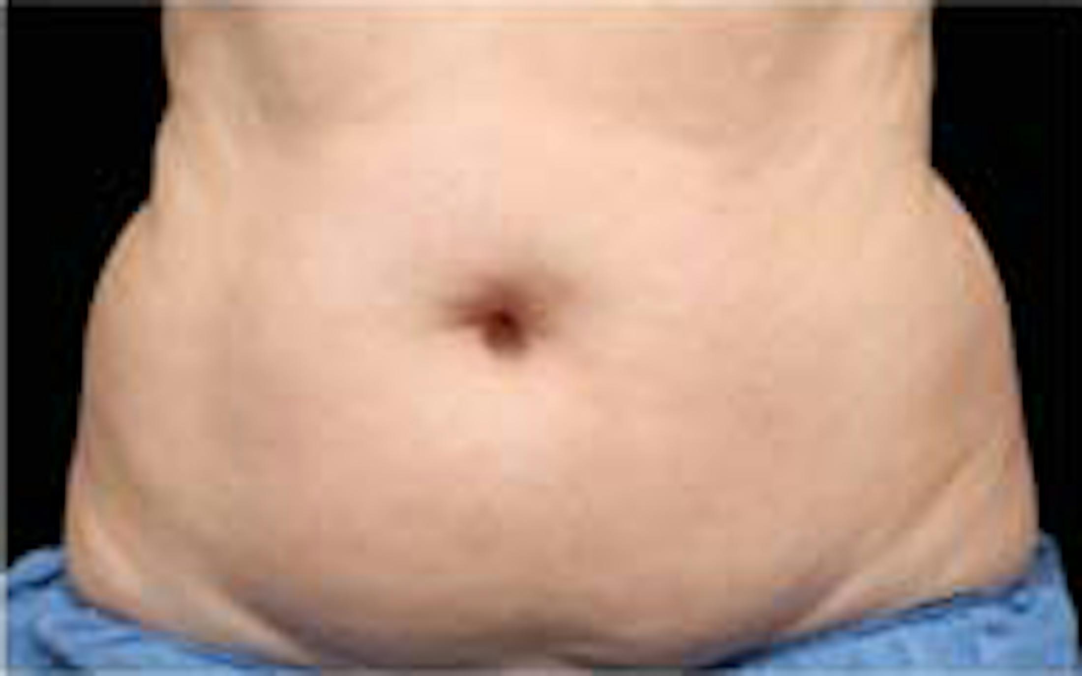 CoolSculpting Elite
