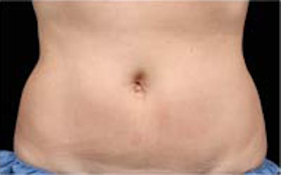 CoolSculpting Elite Before & After Gallery - Patient 65918989 - Image 2