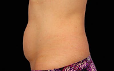 CoolSculpting Elite Before & After Gallery - Patient 65918990 - Image 1