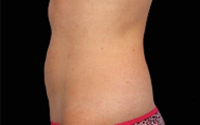 CoolSculpting Elite Before & After Gallery - Patient 65918990 - Image 2