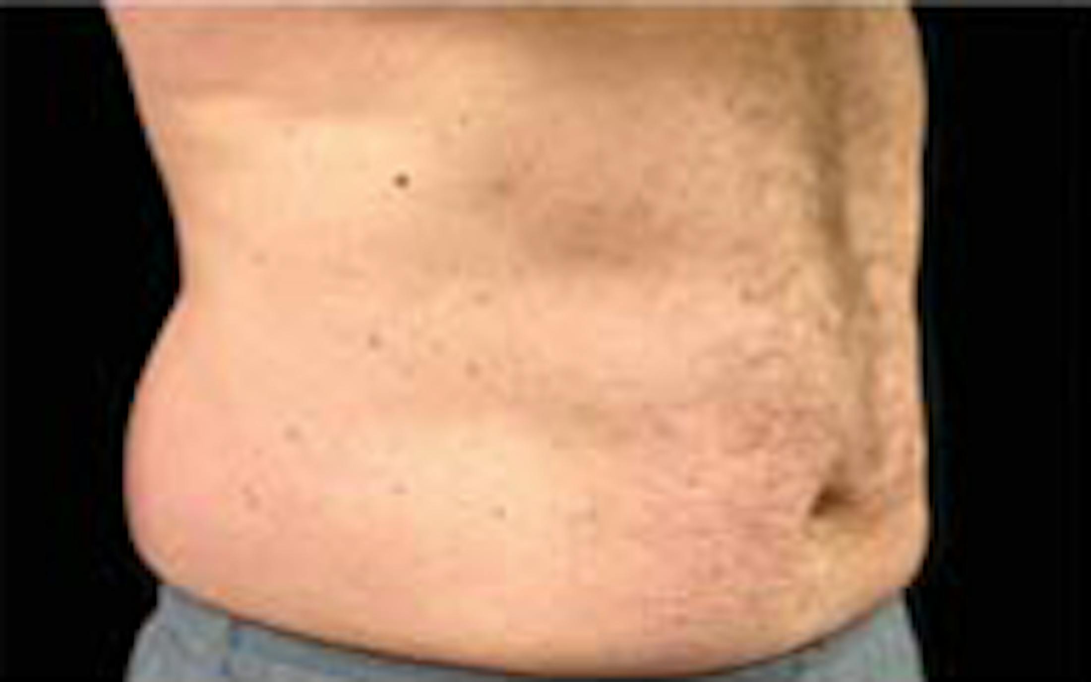CoolSculpting Elite