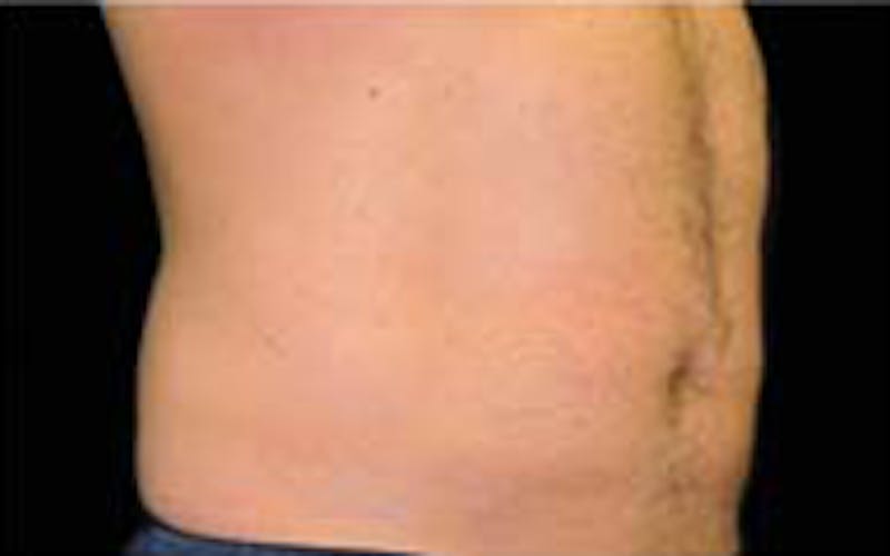 CoolSculpting Elite Before & After Gallery - Patient 65918991 - Image 2