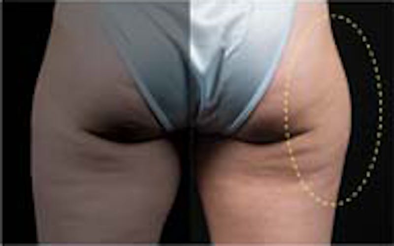 CoolSculpting Elite Before & After Gallery - Patient 65918992 - Image 1