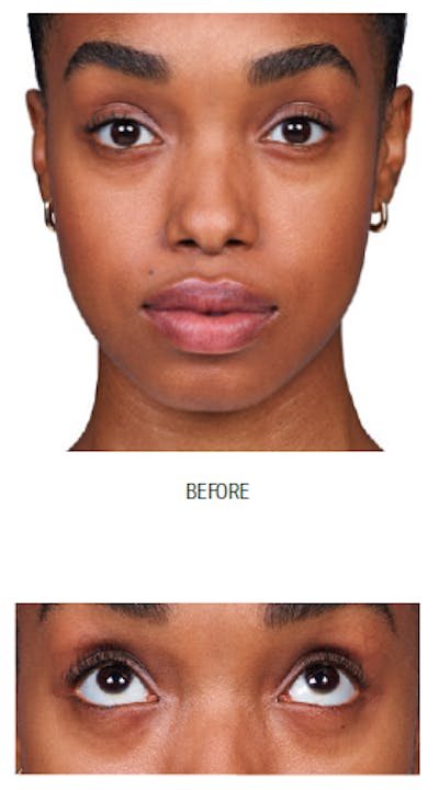 Facial Fillers Before & After Gallery - Patient 105700486 - Image 1