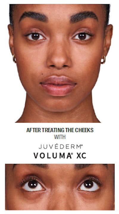 Facial Fillers Before & After Gallery - Patient 105700486 - Image 2