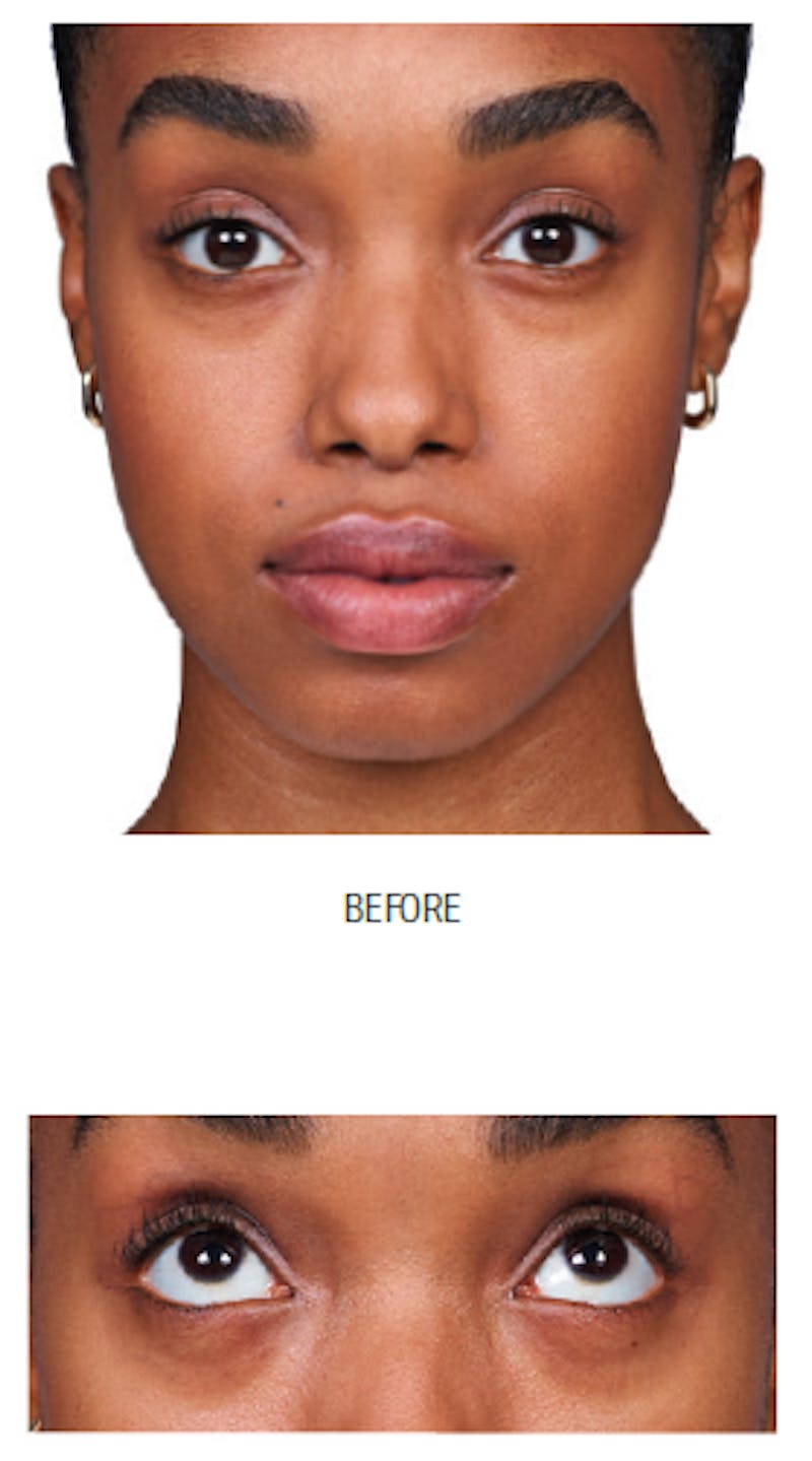 Facial Fillers Before & After Gallery - Patient 105700486 - Image 3