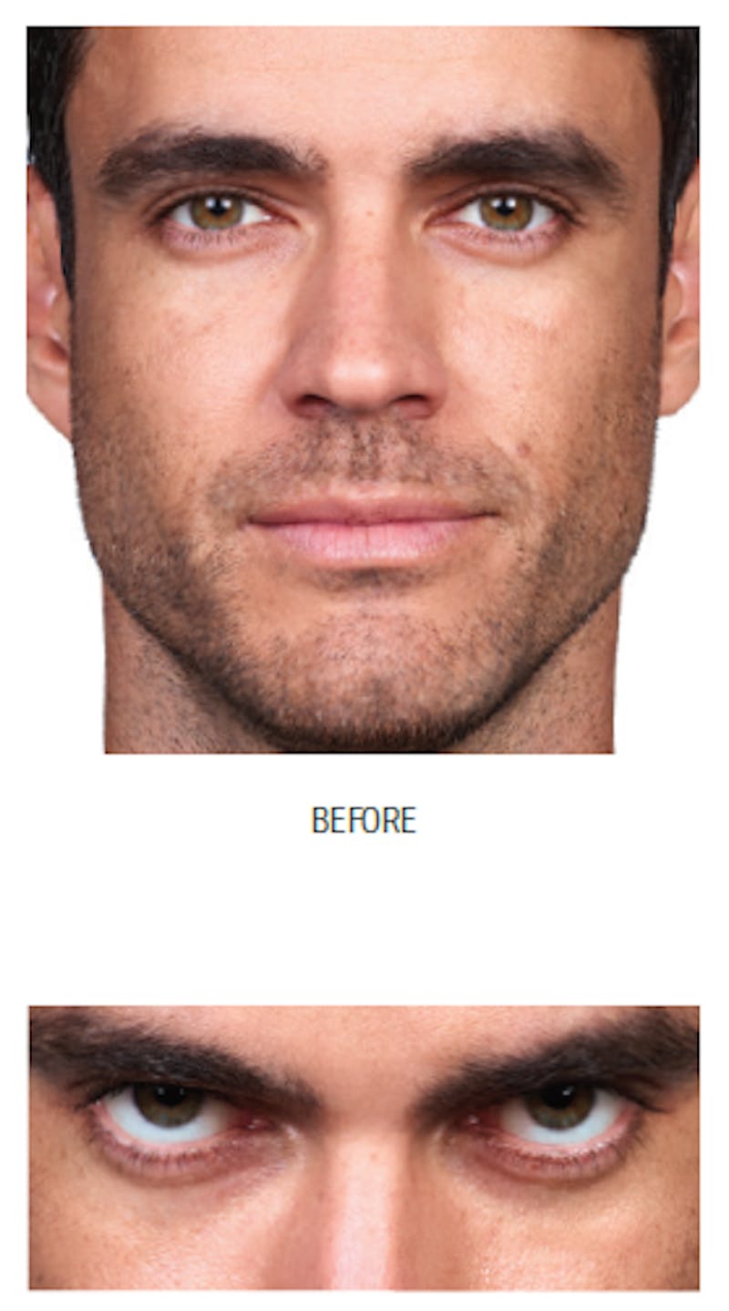 Facial Fillers Before & After Gallery - Patient 105700491 - Image 1
