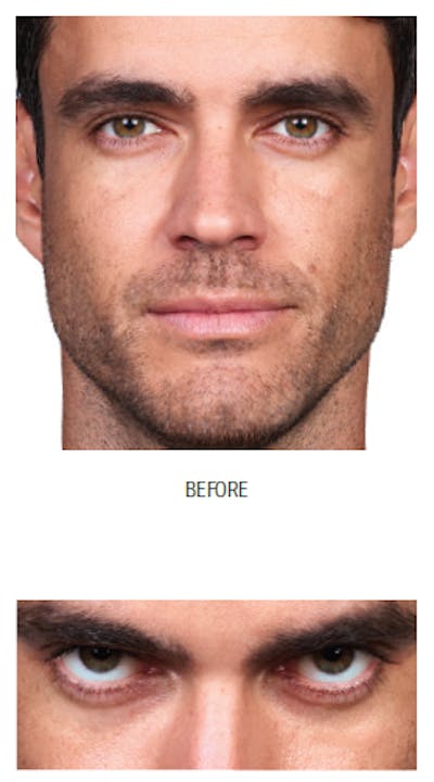 Facial Fillers Before & After Gallery - Patient 105700491 - Image 1