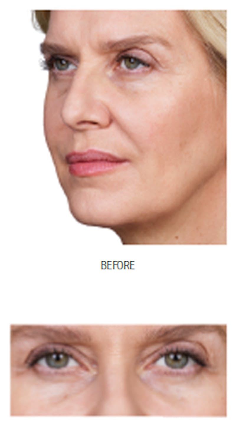 Facial Fillers Before & After Gallery - Patient 105700492 - Image 1