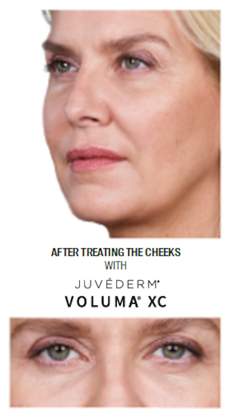 Facial Fillers Before & After Gallery - Patient 105700492 - Image 2
