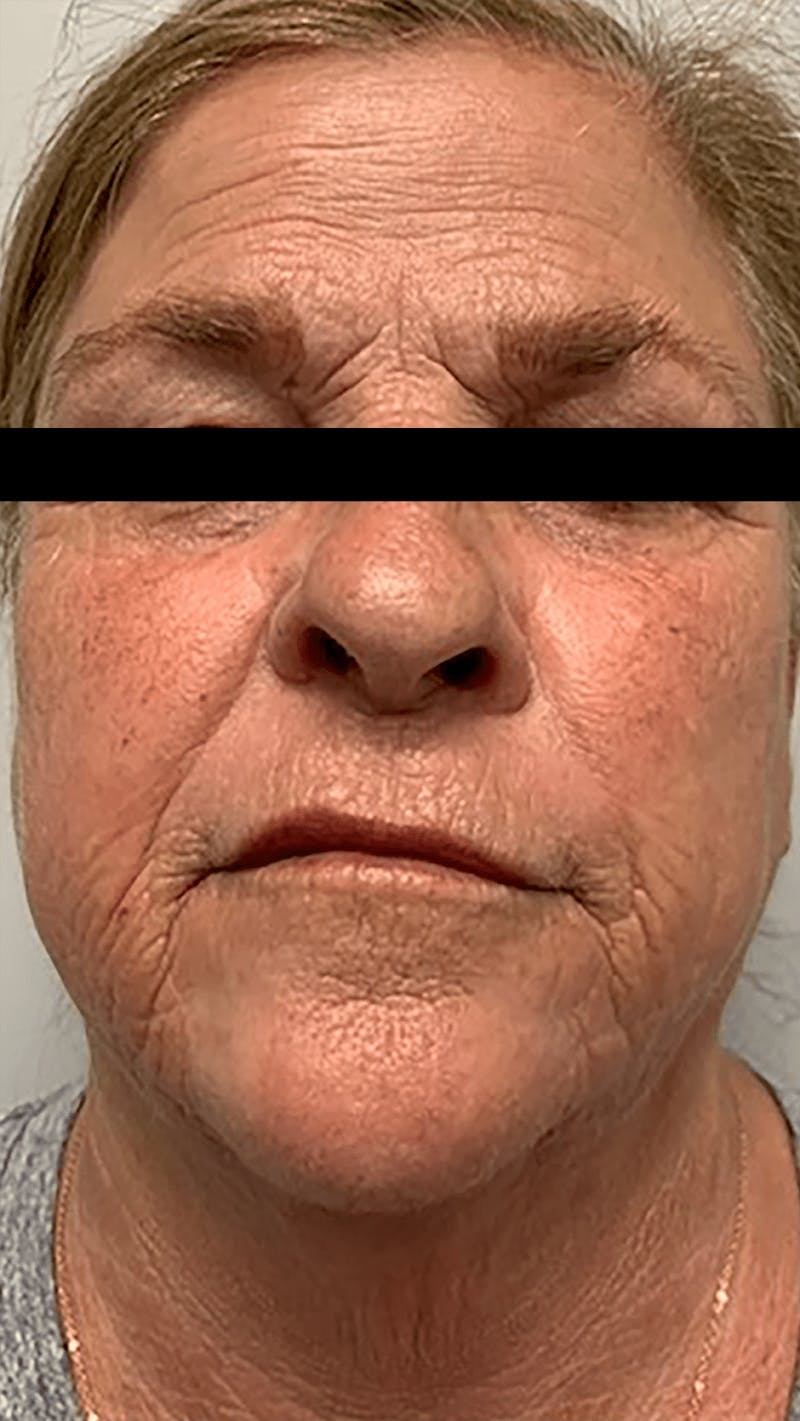 Morpheus8 Before & After Gallery - Patient 65943424 - Image 1