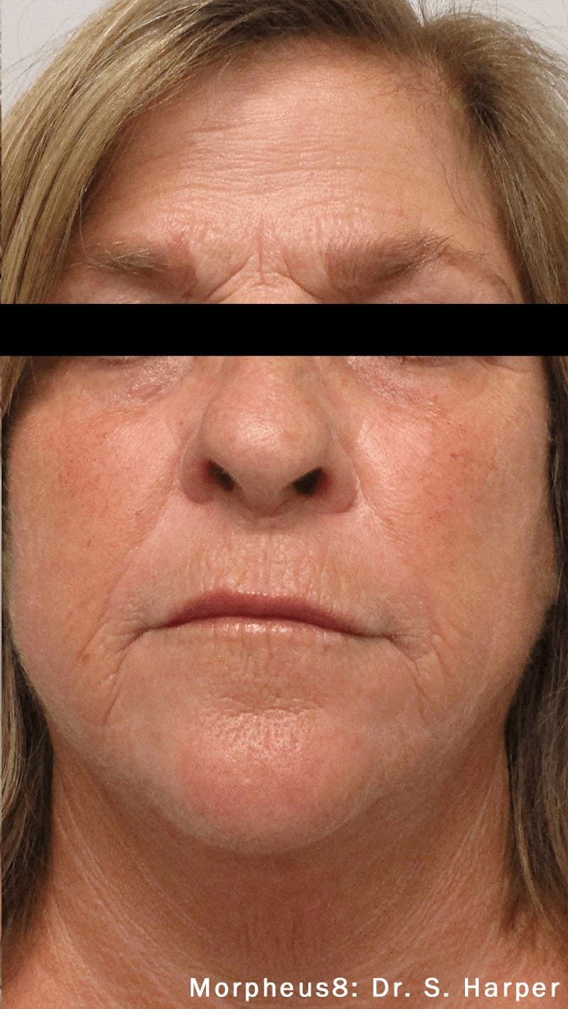 Morpheus8 Before & After Gallery - Patient 65943424 - Image 2