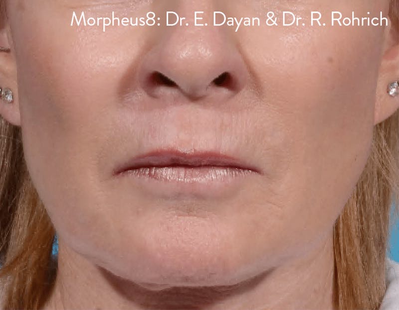 Morpheus8 Before & After Gallery - Patient 65943425 - Image 2