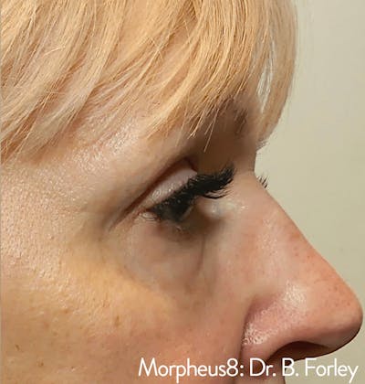 Morpheus8 Before & After Gallery - Patient 65943426 - Image 2
