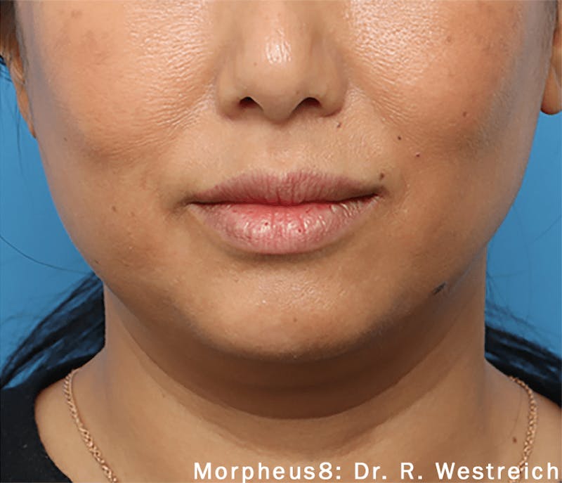 Morpheus8 Before & After Gallery - Patient 65943427 - Image 2