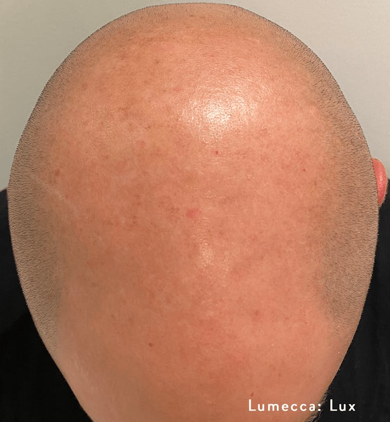 Lumecca Before & After Gallery - Patient 65943439 - Image 2