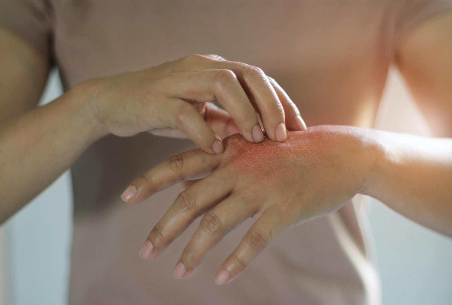 person with a rash on their hand