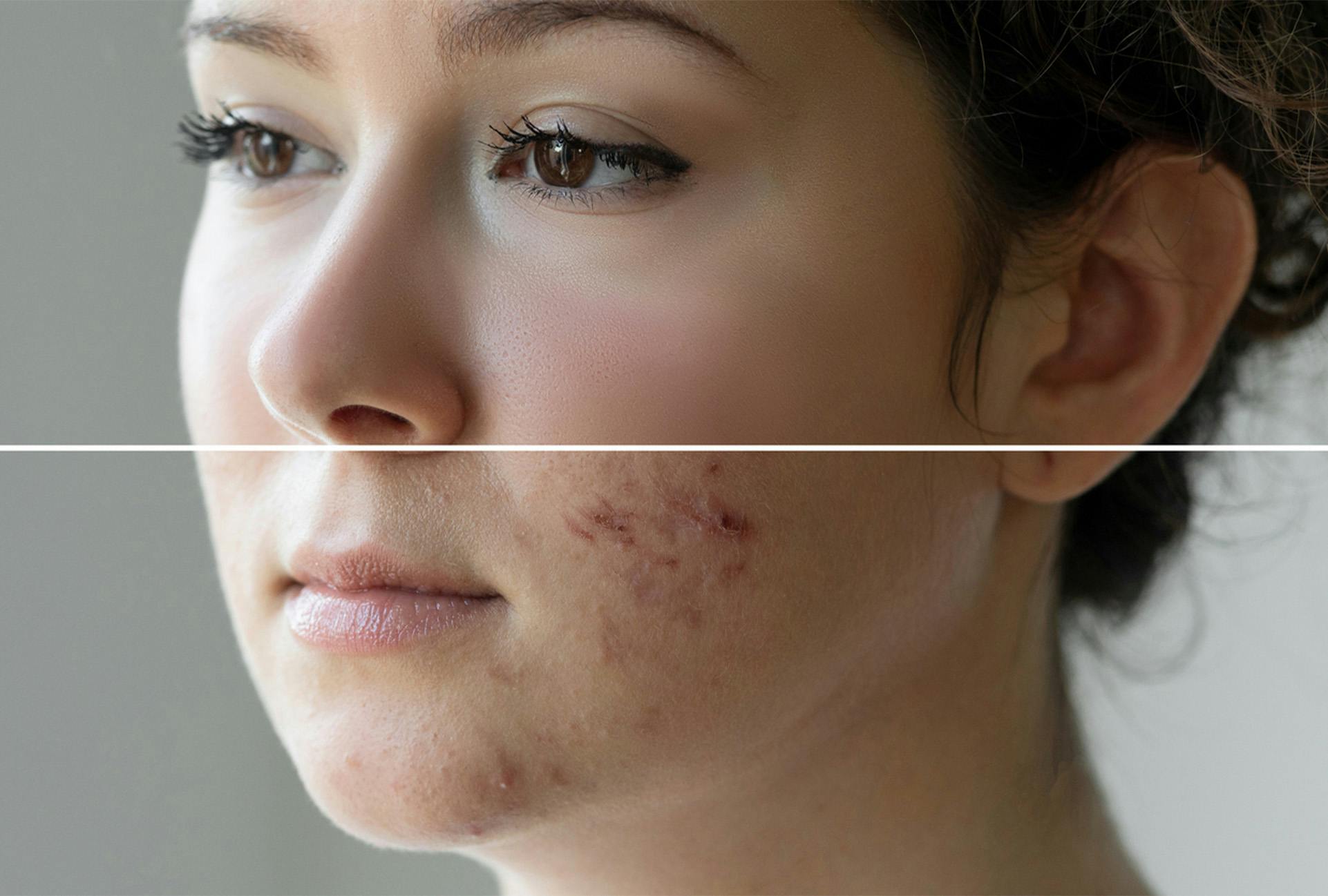 comparison of skin with and without acne