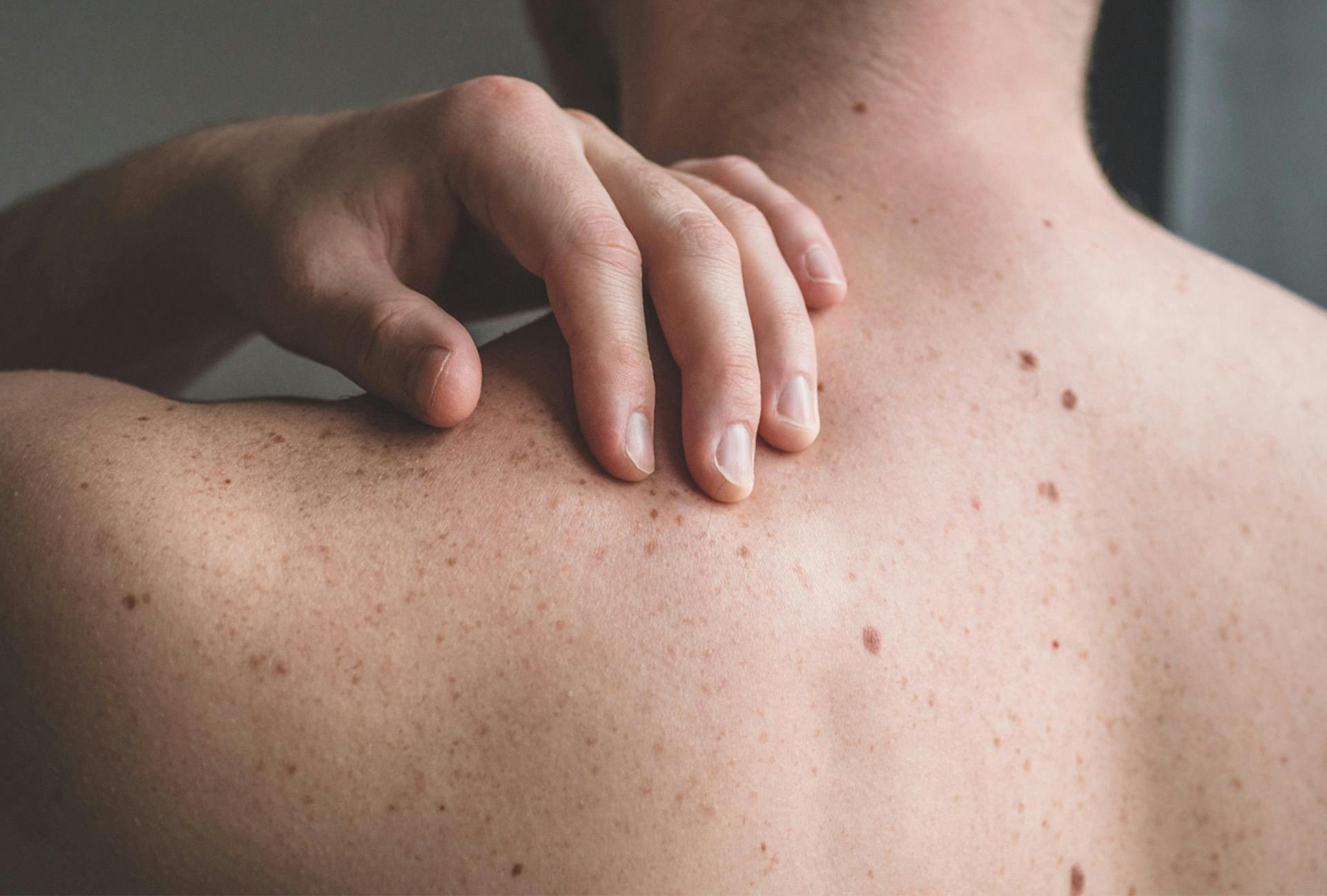 Persons bare back with moles and freckles