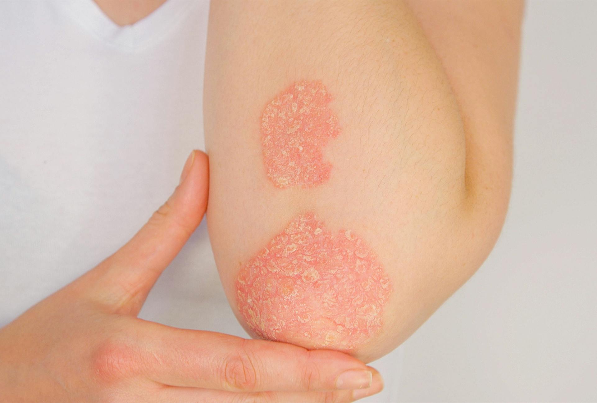 Nedrustning Ud over Mursten Psoriasis | The Dermatology Center