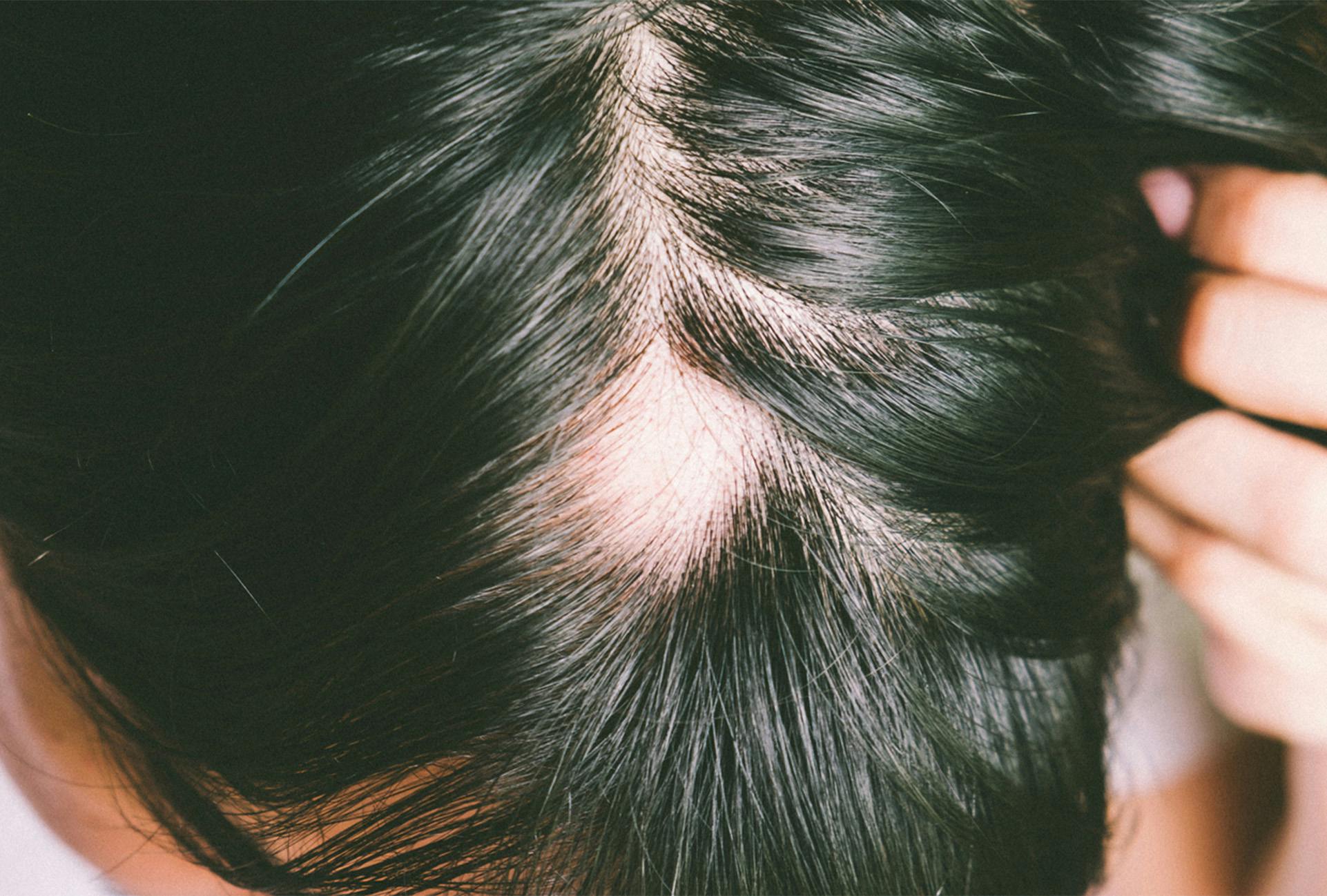 person experiencing hair loss