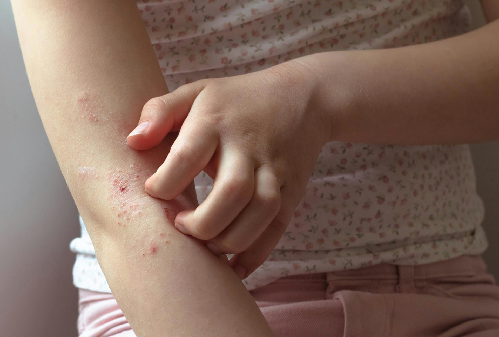 person scratching their eczema