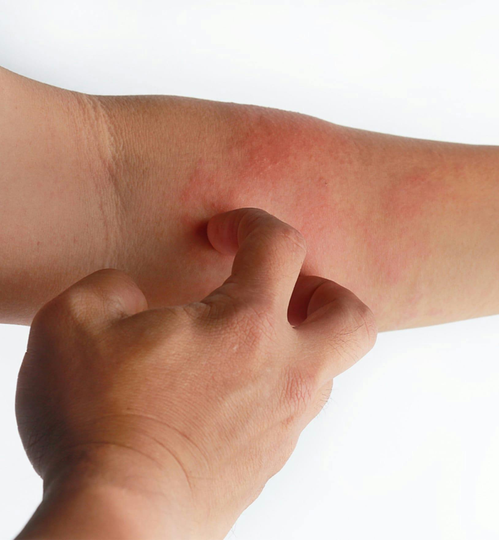 person scratching their eczema