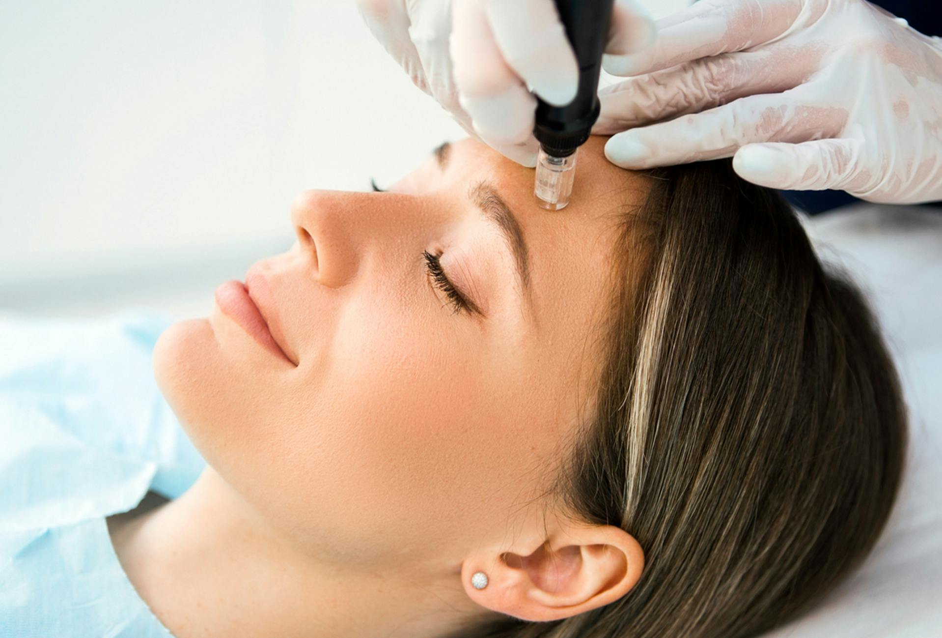 woman getting microneedling procedure done