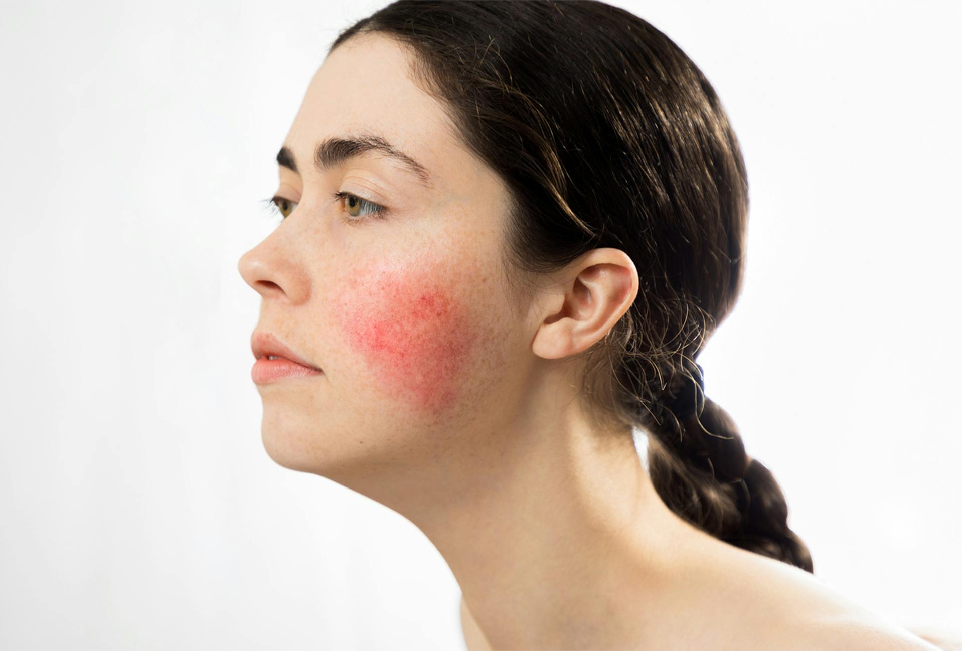 Woman with rosacea on her cheek