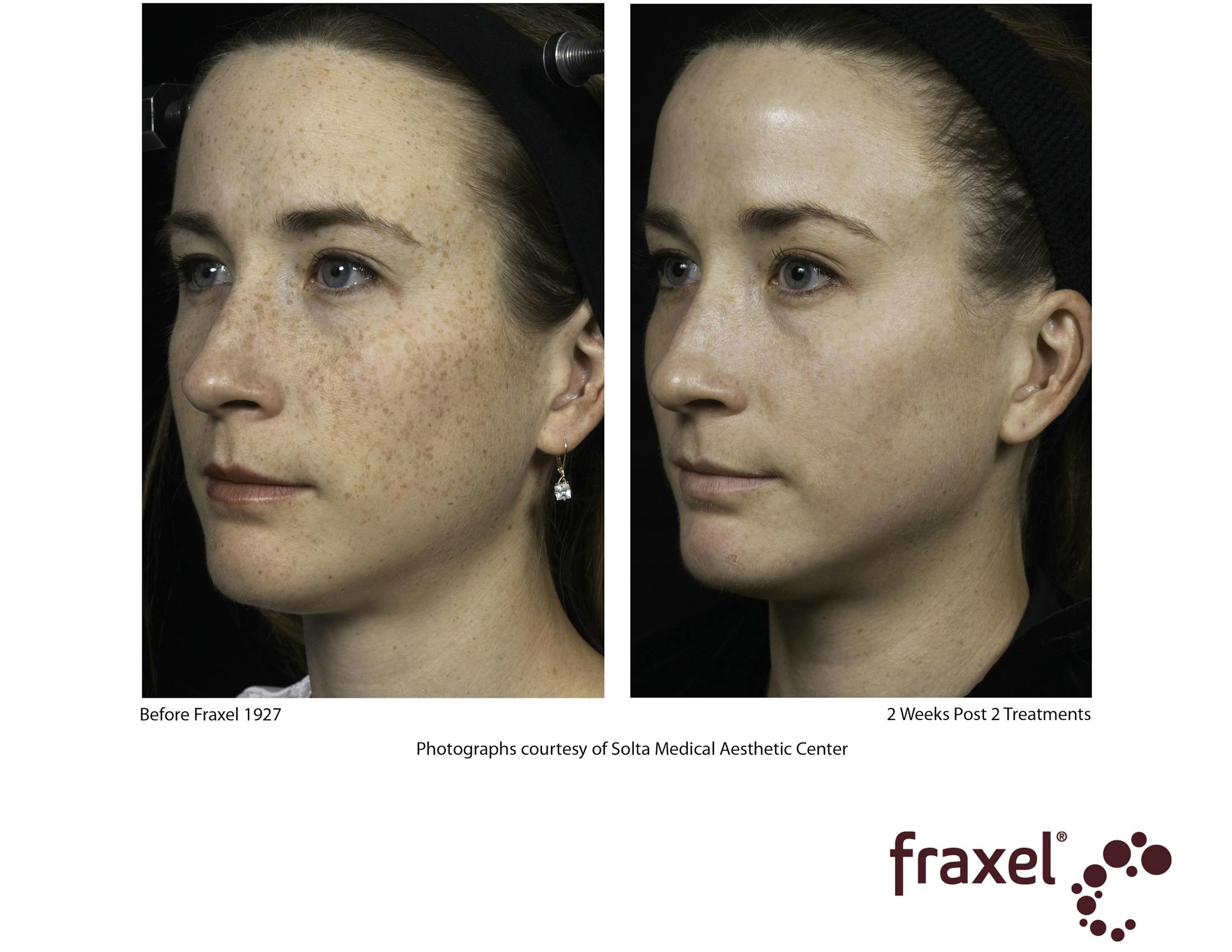 Fraxel Restore Before & After Gallery - Patient 99108379 - Image 1
