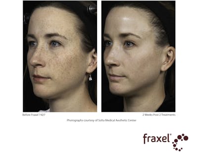 Fraxel Restore Before & After Gallery - Patient 99108379 - Image 1