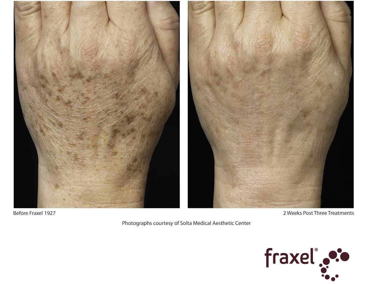 Fraxel Restore Before & After Gallery - Patient 99108383 - Image 1