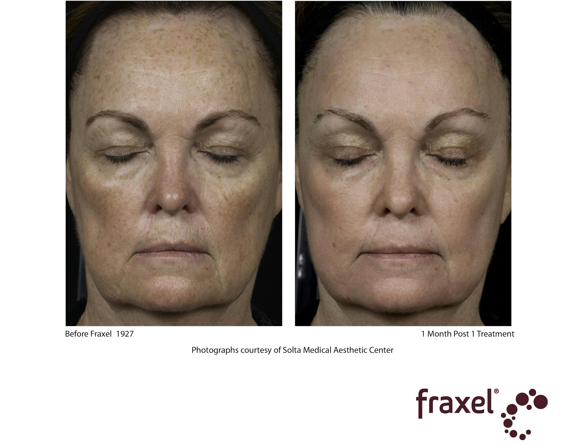 Fraxel Restore Before & After Gallery - Patient 99108380 - Image 1