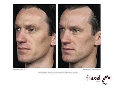 Fraxel Restore Before & After Gallery - Patient 99108381 - Image 1