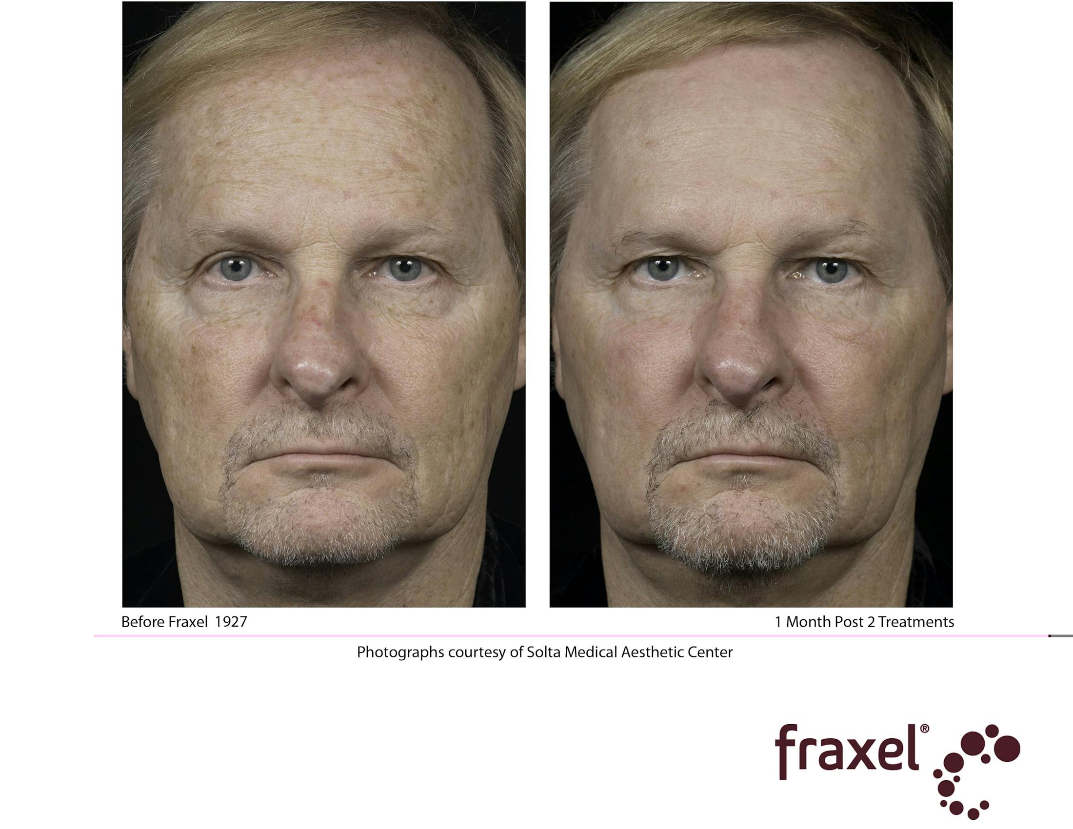 Fraxel Restore Before & After Gallery - Patient 99108382 - Image 1