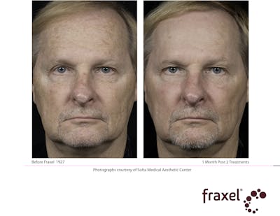 Fraxel Restore Before & After Gallery - Patient 99108382 - Image 1