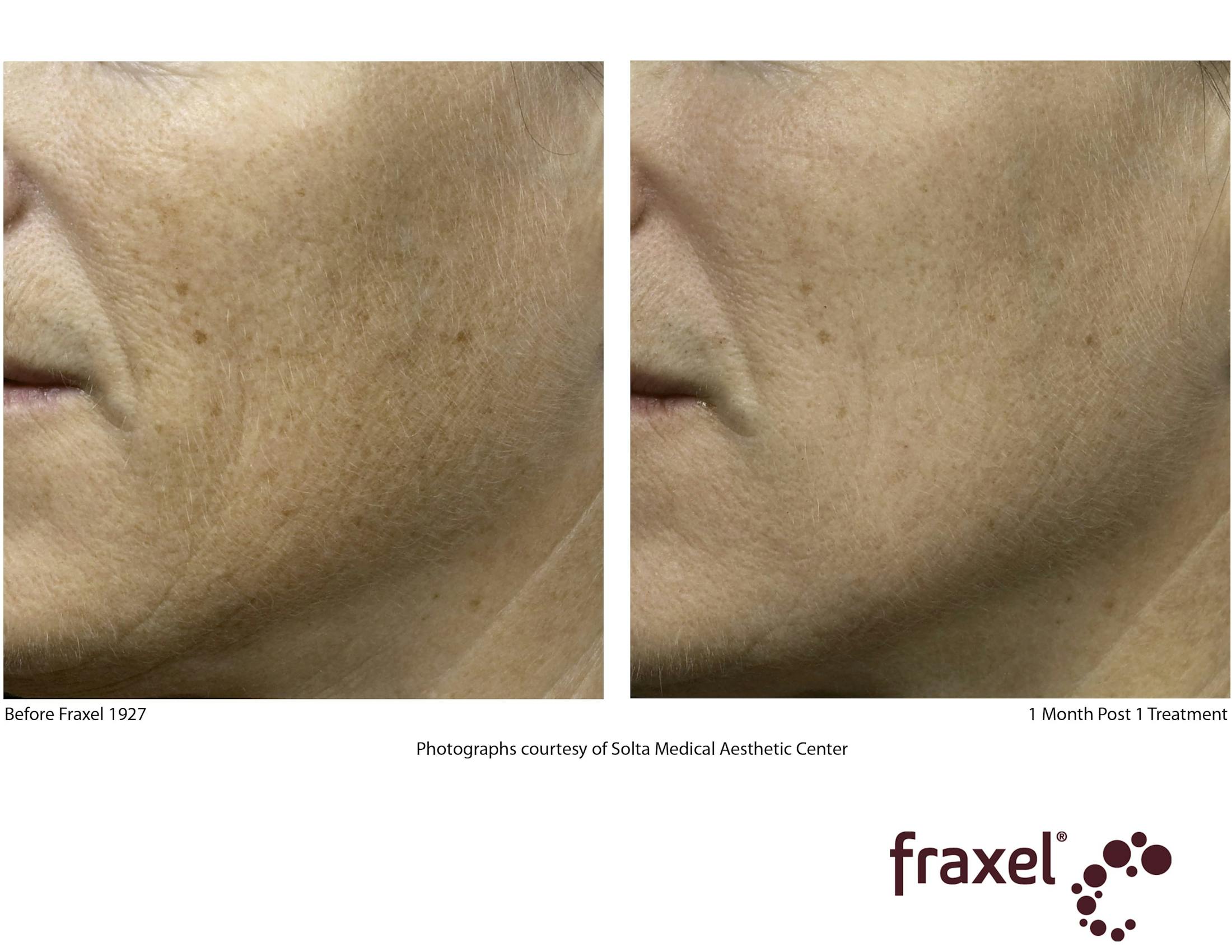 Fraxel Restore Before & After Gallery - Patient 99108384 - Image 1