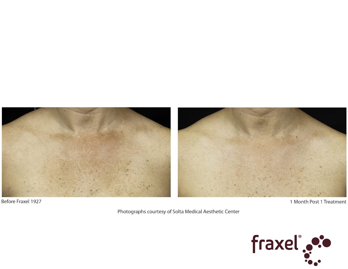 Fraxel Restore Before & After Gallery - Patient 99108385 - Image 1