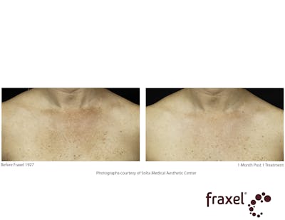 Fraxel Restore Before & After Gallery - Patient 99108385 - Image 1