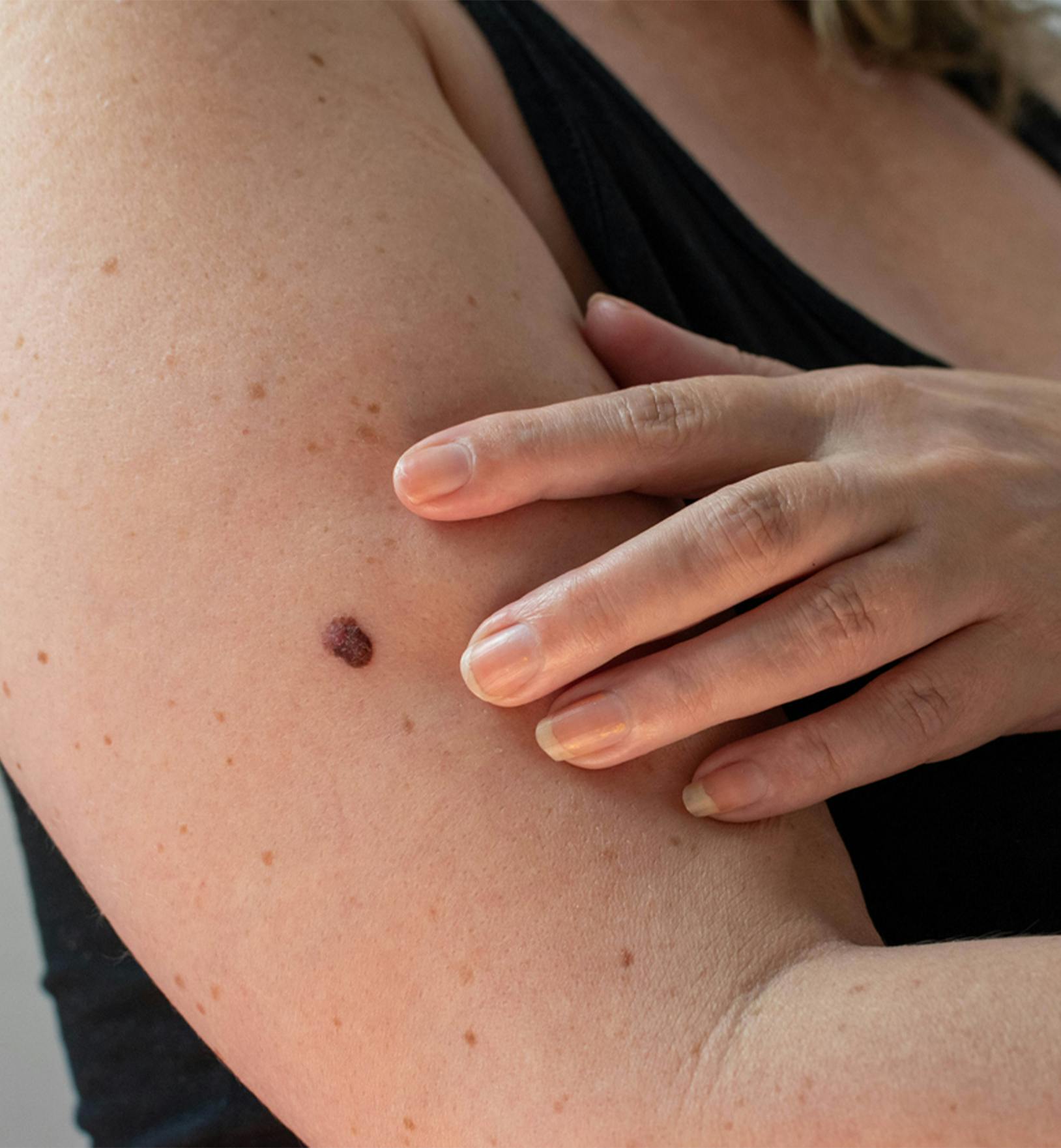person with mole on their arm
