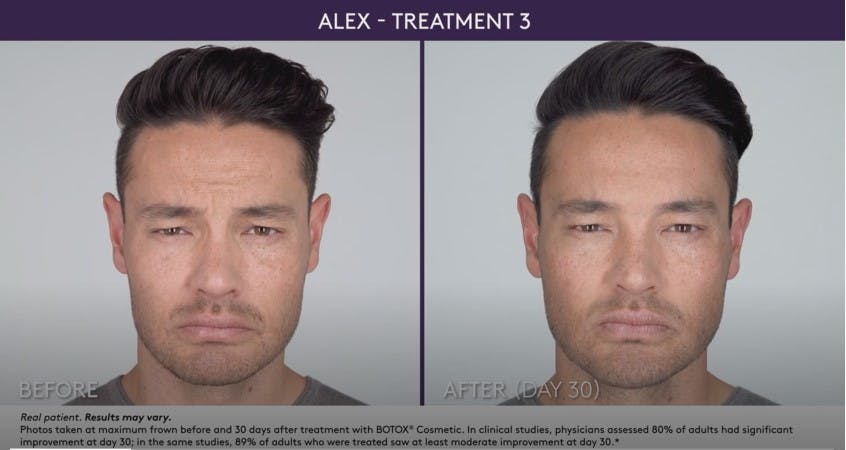 BOTOX Before & After Gallery - Patient 105702577 - Image 1