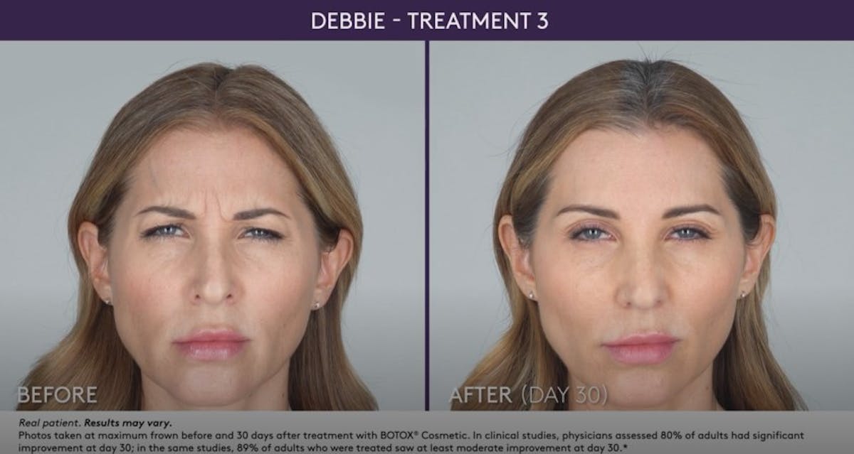 BOTOX Before & After Gallery - Patient 105702578 - Image 1