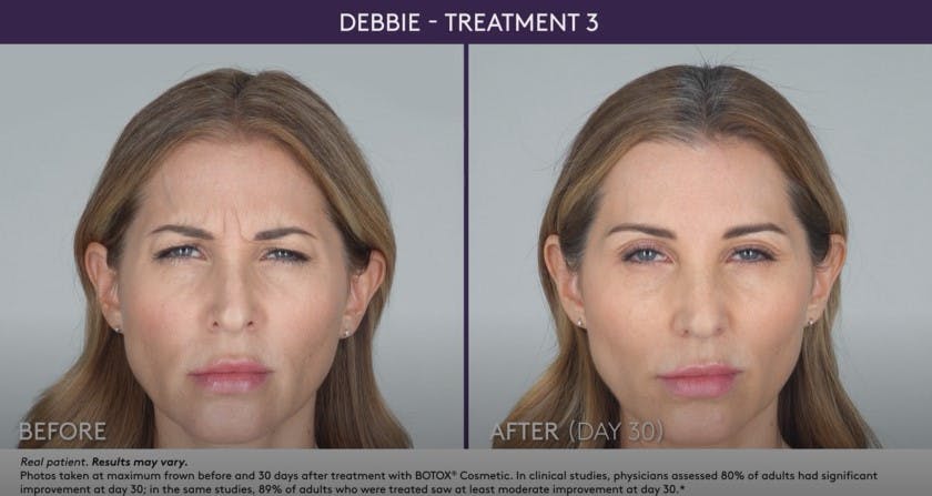 BOTOX Before & After Gallery - Patient 105702578 - Image 1