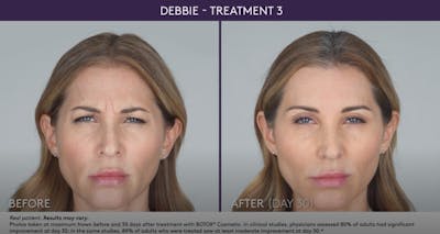BOTOX Before & After Gallery - Patient 105702578 - Image 1
