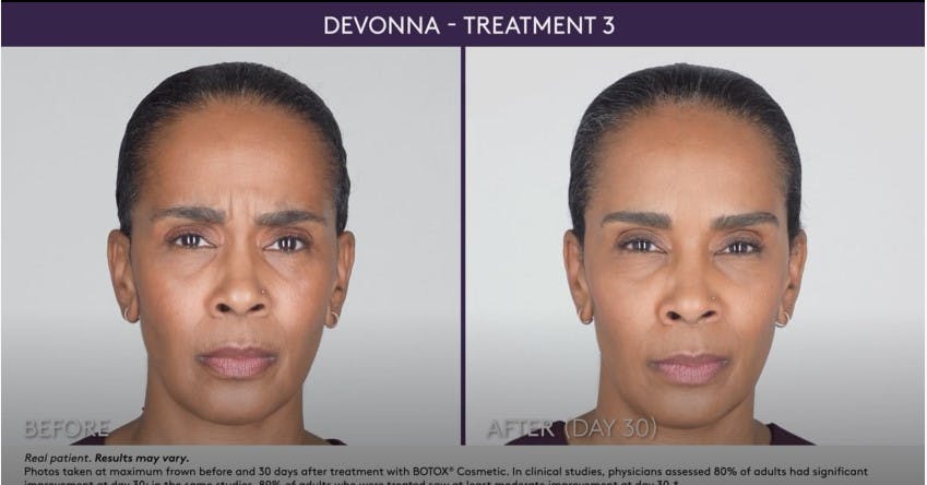 BOTOX Before & After Gallery - Patient 105702579 - Image 1
