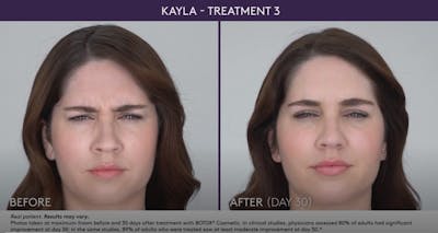 BOTOX Before & After Gallery - Patient 105702580 - Image 1