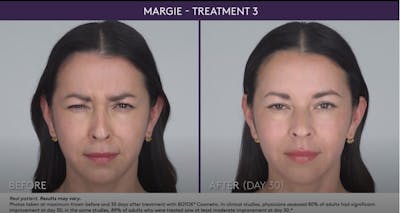 BOTOX Before & After Gallery - Patient 105702581 - Image 1